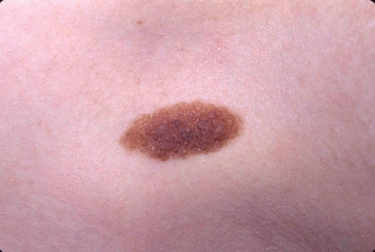 reconnaitre un simple naevus d'un melanome ou grain de beauté malin