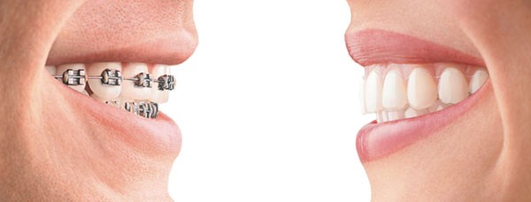 les orthodontistes pour adultes proposent des traitements pour l'alignement dentaire
