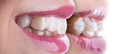 les aligneurs dentaires sont une excellente alternative aux bagues traditionnelles